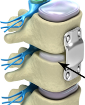 Anterior Cervical Discectomy and Fusion