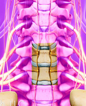 Cervical Discectomy