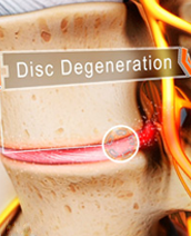 Degenerative Disc(s)