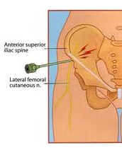 Genitofemoral / Ilioinguinal Nerve Blocks & Pulsed EMF