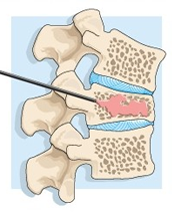 Kyphoplasty / Vertebroplasty