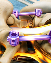 Lateral Lumbar Interbody Stabilizationy