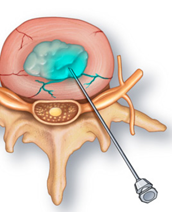 Lumbar Discography