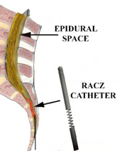 Lysis of Adhesions - Racz Catheter