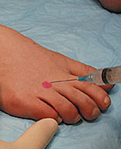 Neuroma Injections & RFTC