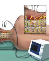 Radiofrequency Thermocoagulation (RFTC)