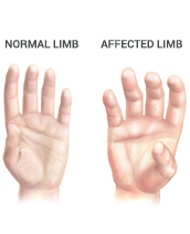 Reflex Sympathetic Dystrophy