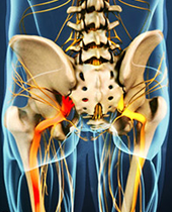 Sciatica