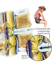 Selective Nerve Root Block